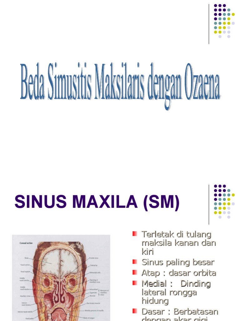 Sinusitis Maxillaris vs Ozaena by Miong