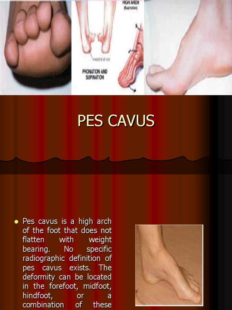 Pes Cavus .... | PDF | Foot | Musculoskeletal System