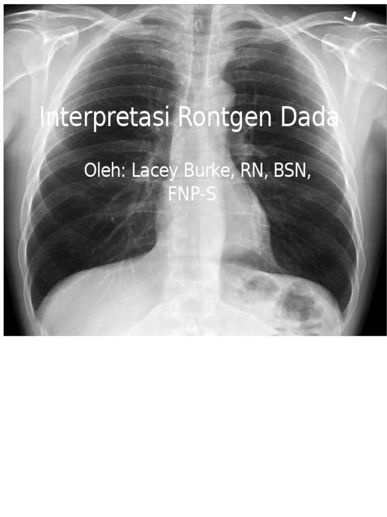 Panduan Interpretasi Rontgen Dada | PDF