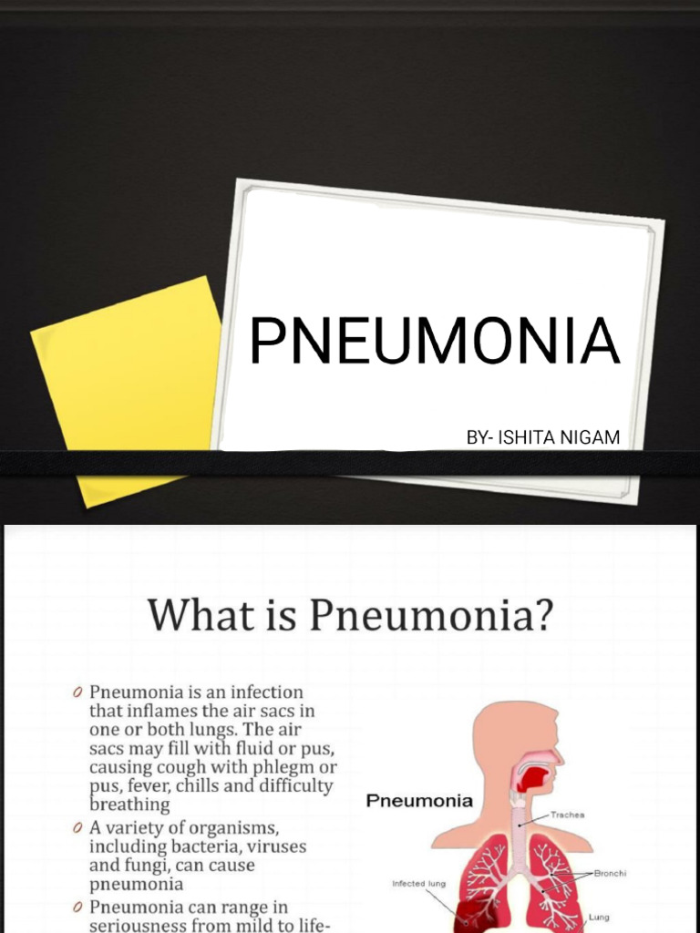 Pneumonia Final | PDF