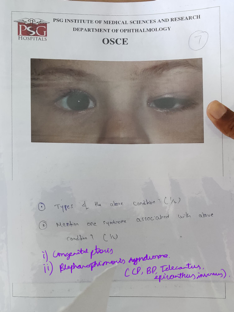 Ophthal Spotters | PDF