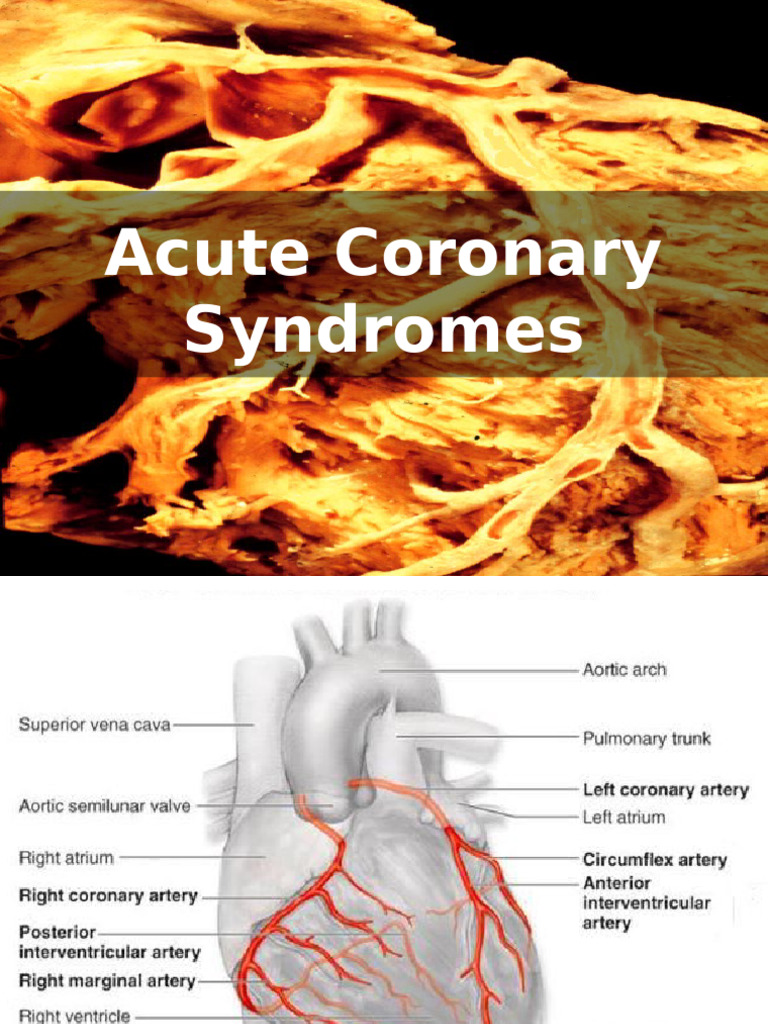 Acute Coronary Syndrome Overview | PDF | Myocardial Infarction ...
