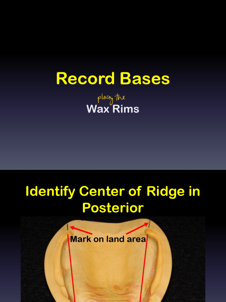Maxillary and Mandibular Wax Rim Guide | PDF