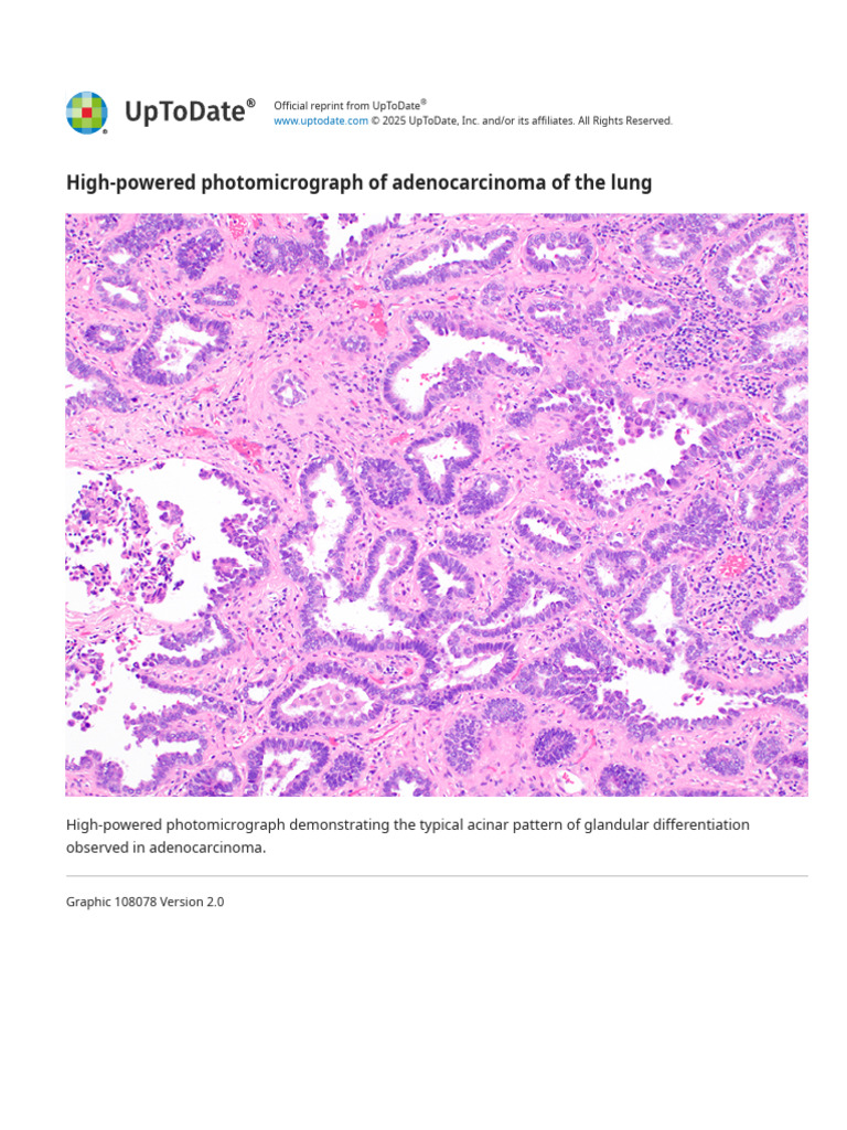 High-Powered Photomicrograph of Adenocarcinoma of The Lung - UpToDate | PDF