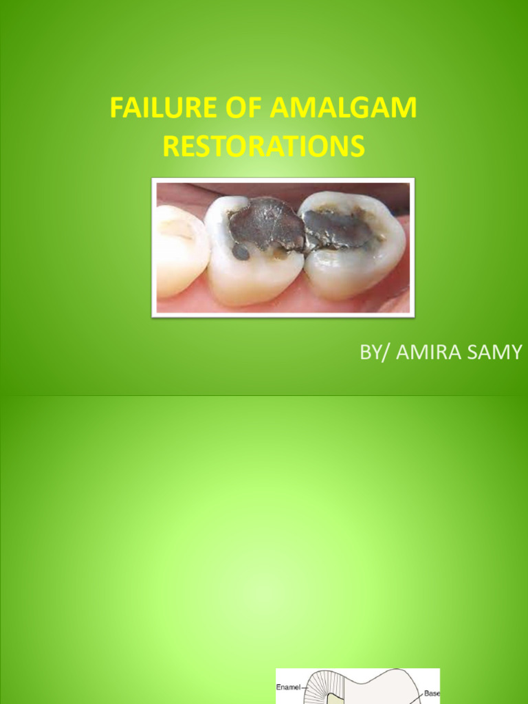 Failure of Amalgam | PDF | Periodontology | Human Tooth