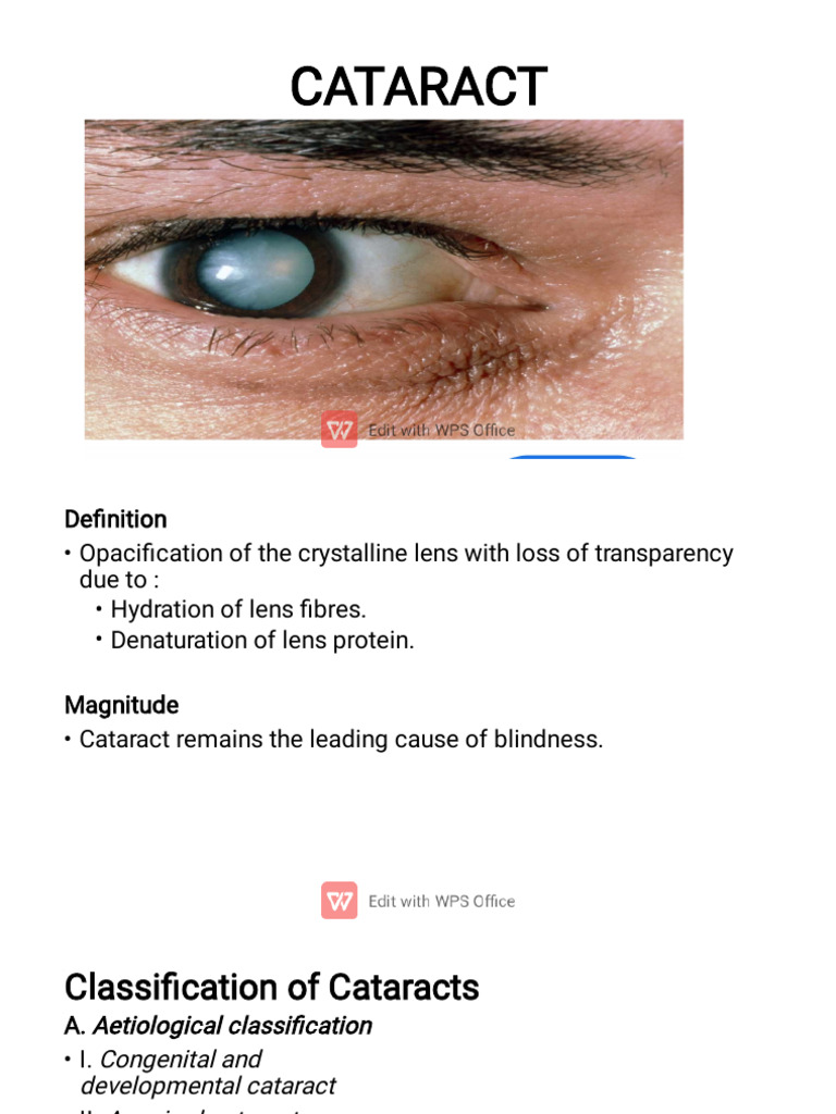 Cataract | PDF