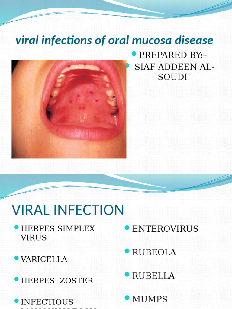 Viral Infections of Oral Mucosa Disease by FAIF ADDEEN ALSOUDI | PDF ...
