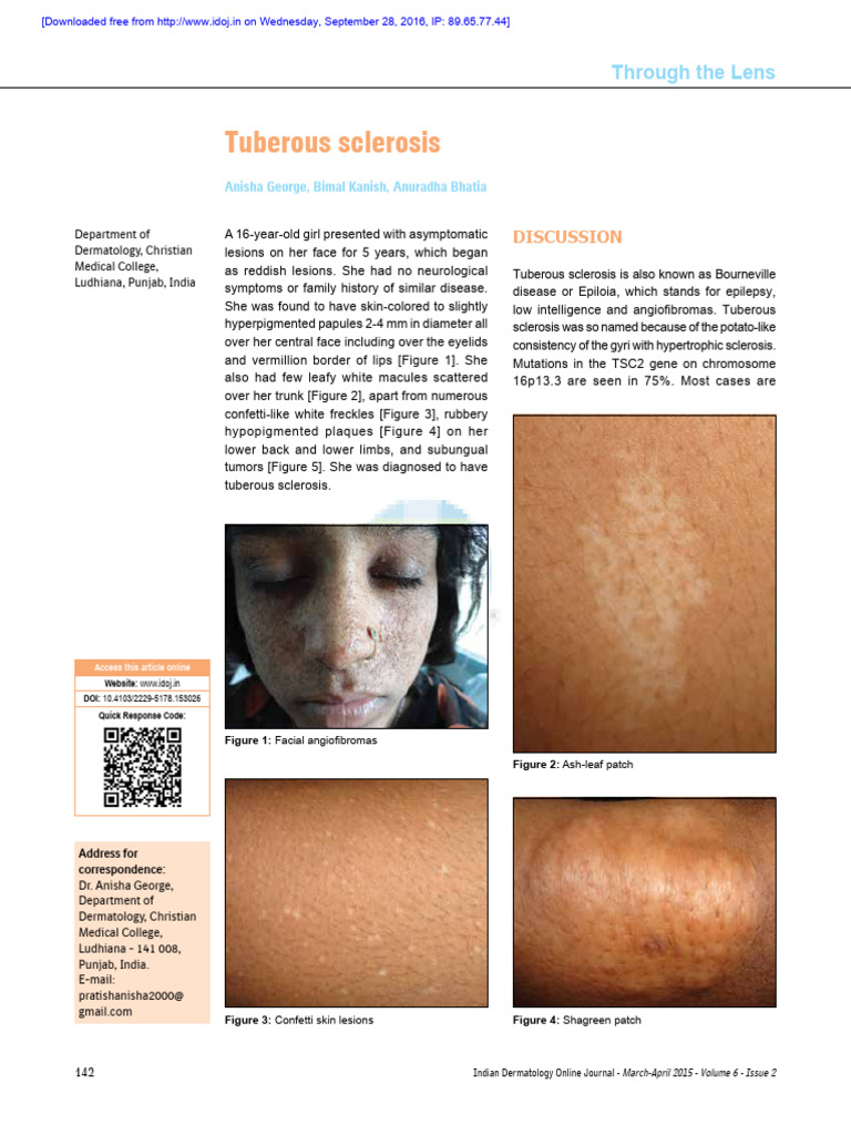 Tuberous Sclerosis | PDF | Diseases And Disorders | Endocrine System