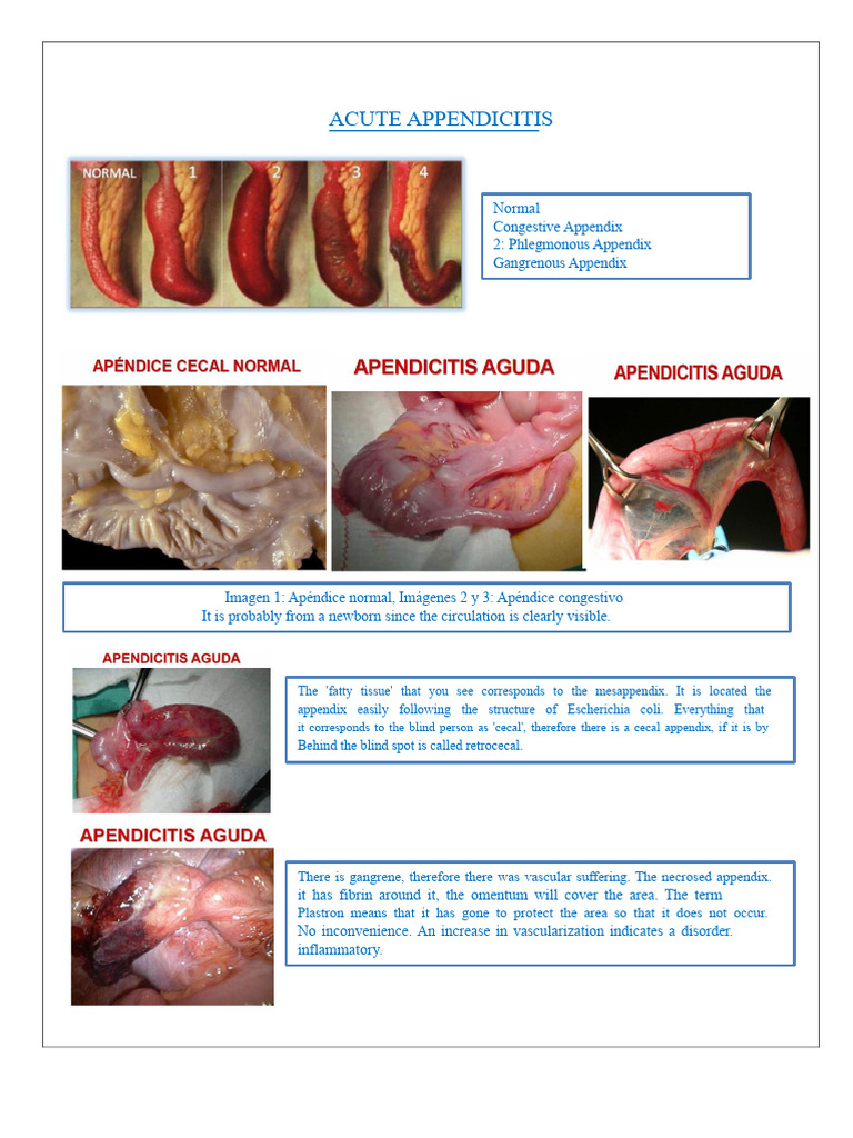 ACUTE APPENDICITIS - Dr. Pino | PDF | Peritoneum | Medical Specialties