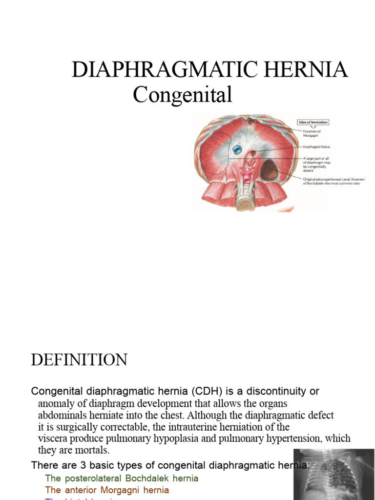 Understanding Congenital Diaphragmatic Hernia | PDF | Diseases And ...