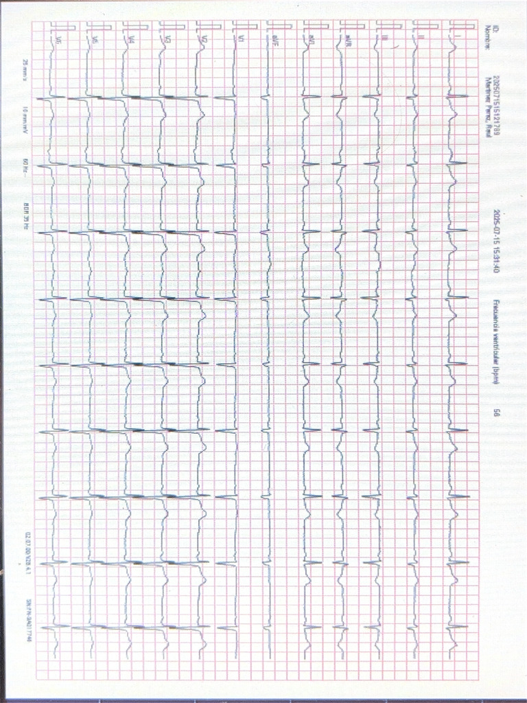 Ekg 1119 | PDF