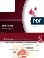 Epistaxis