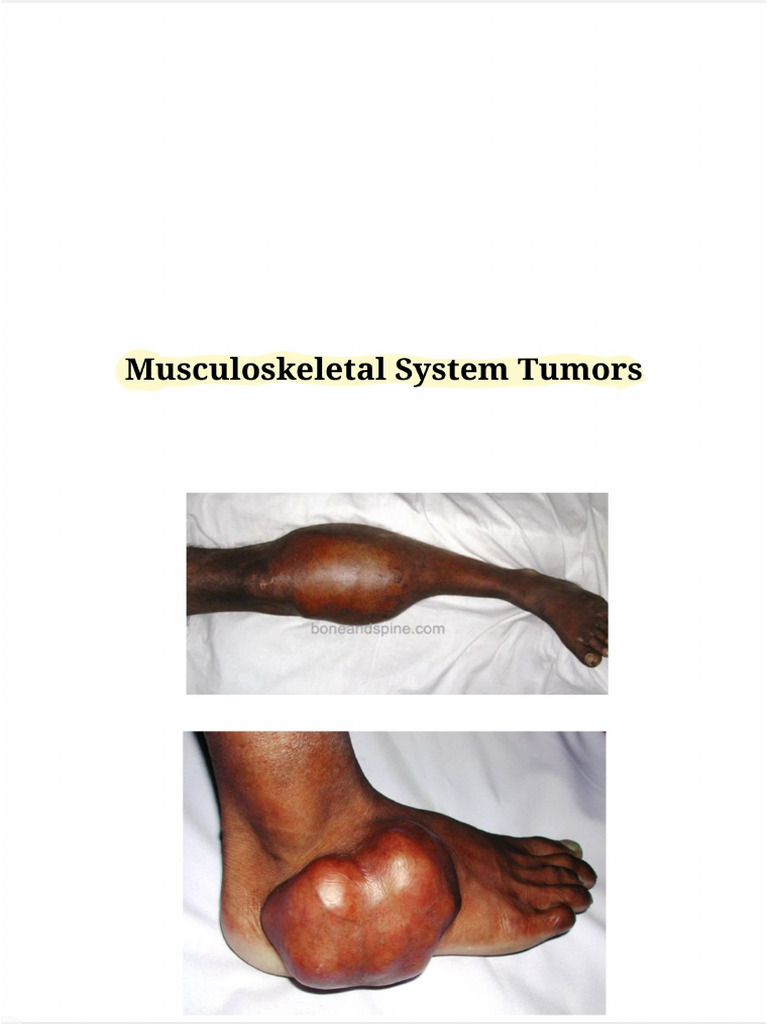 Musculoskeletal Tumors | PDF