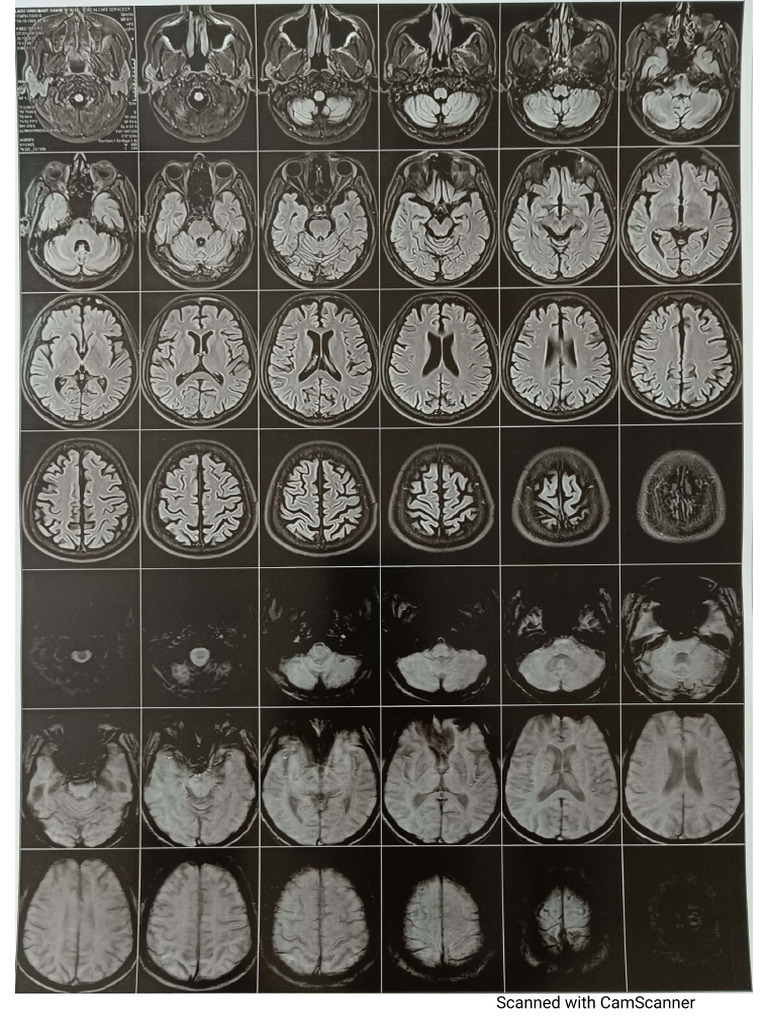 Normal MRI | PDF