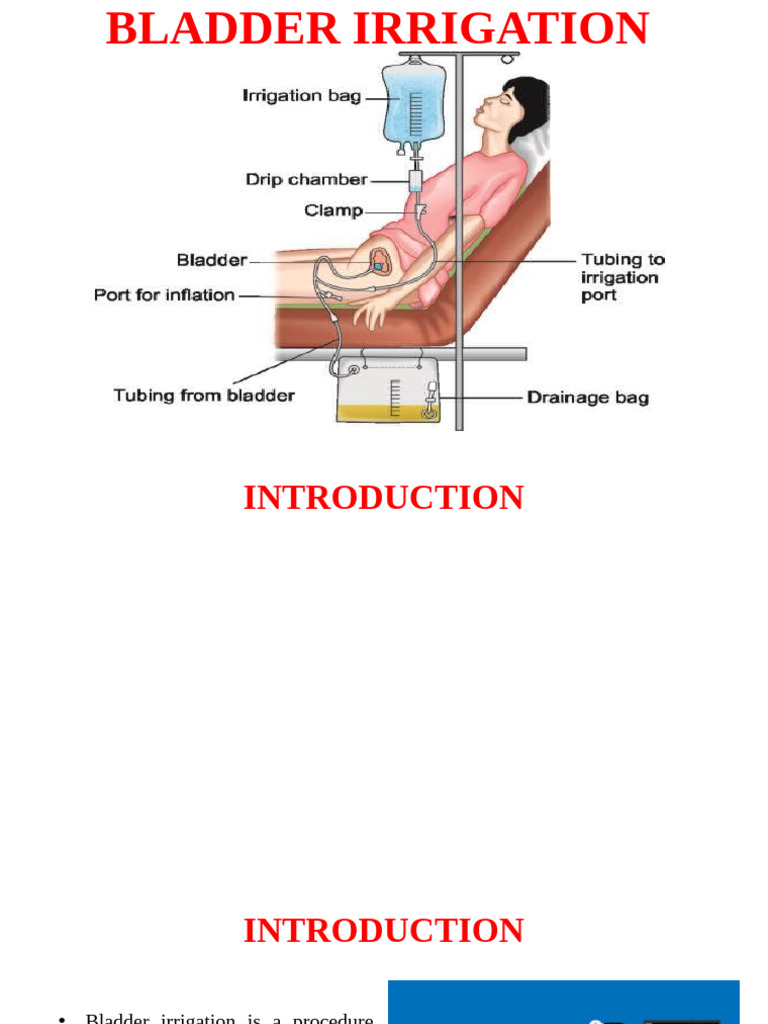 Bladder Irrigation: Procedure Guide | PDF