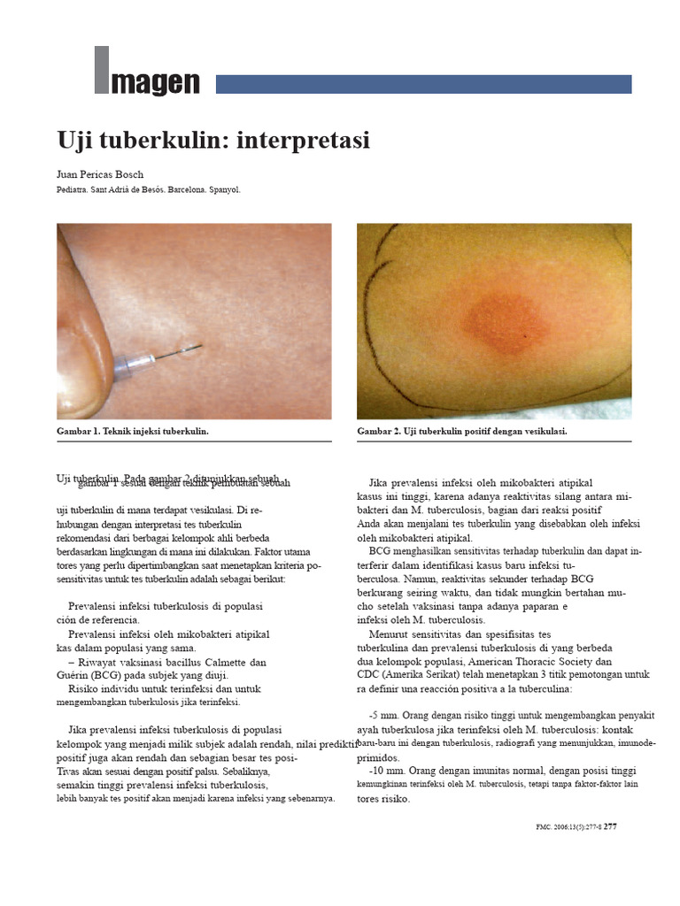 Interpretasi Uji Tuberkulin pada Anak | PDF