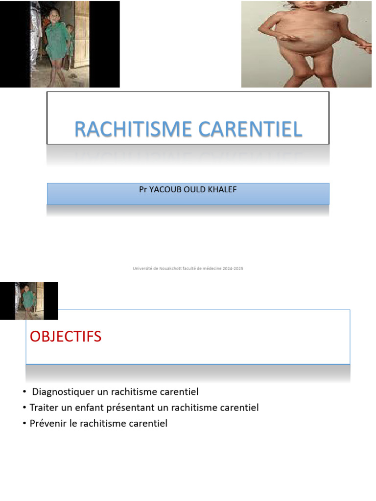 Rachitisme Carentiel : Diagnostic et Traitement | PDF | Vitamine D ...