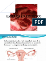 Embarazo Ectopico