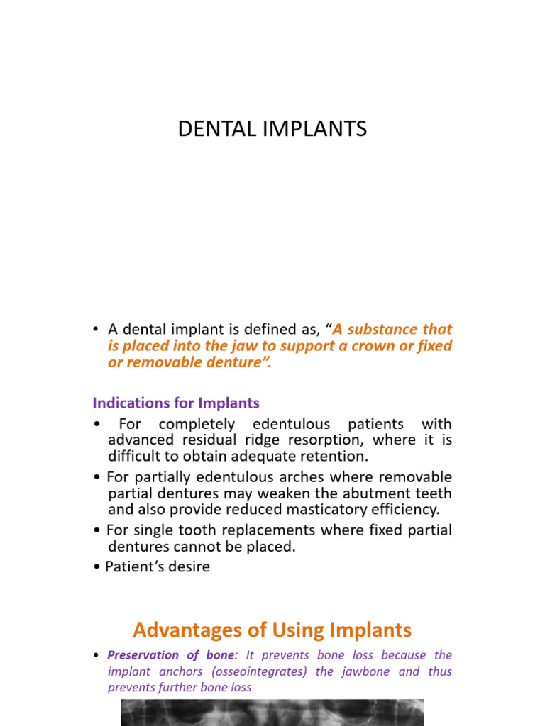 Comprehensive Guide to Dental Implants | PDF | Dental Implant | Dentures