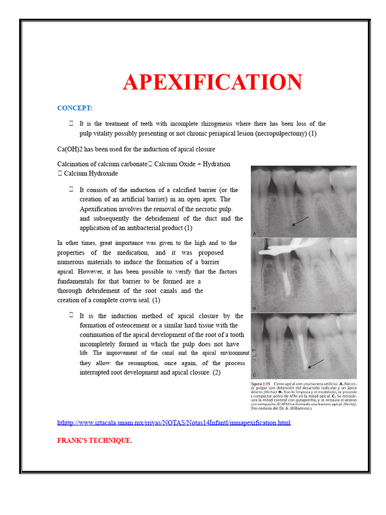 Apexification Procedure for Dental Care | PDF | Medical Specialties ...