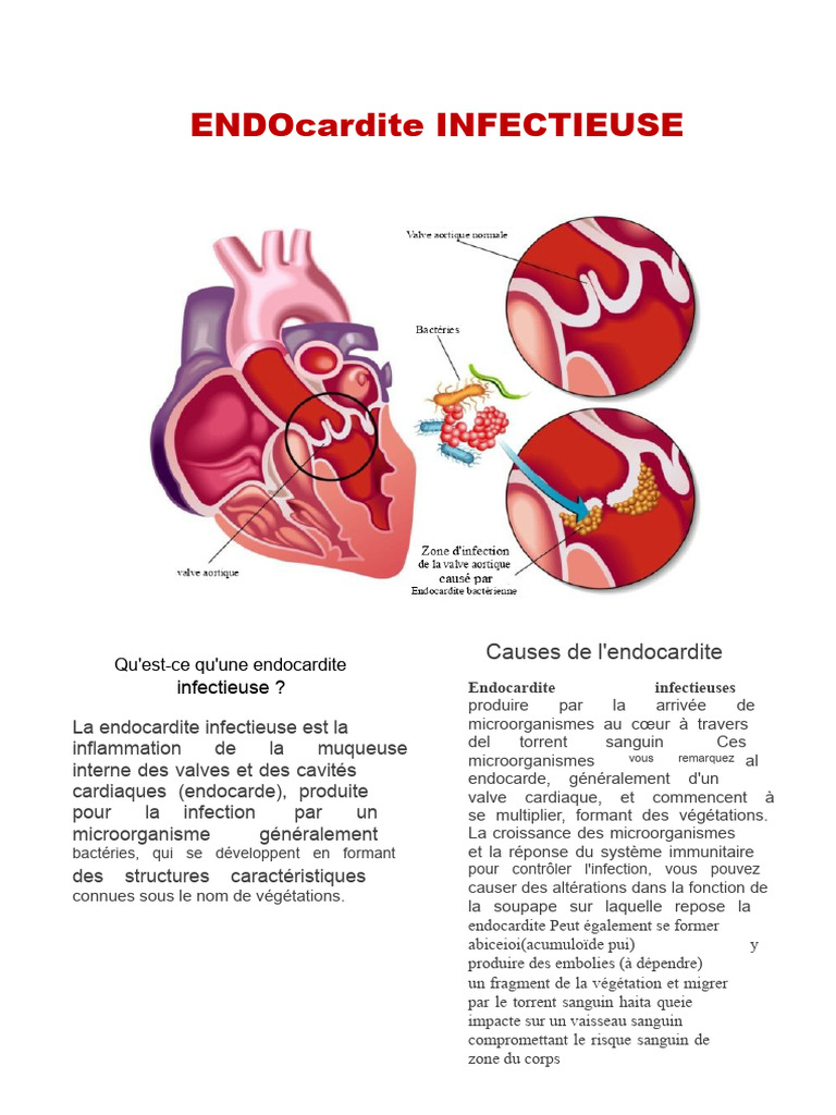 Comprendre l'endocardite infectieuse | PDF | Infection | Médecine clinique