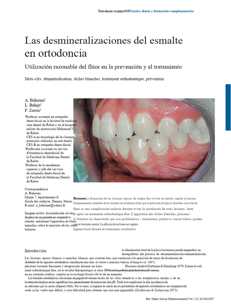 Desmineralización del esmalte en ortodoncia | PDF | Ortodoncia ...