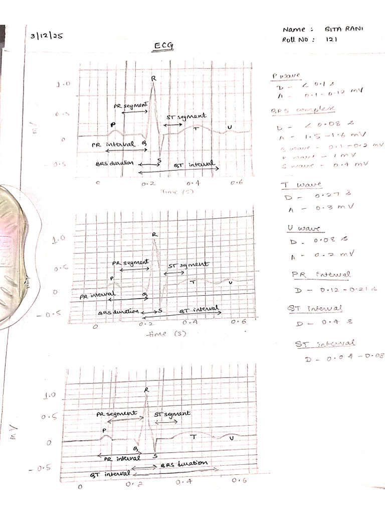 ECG Graph | PDF