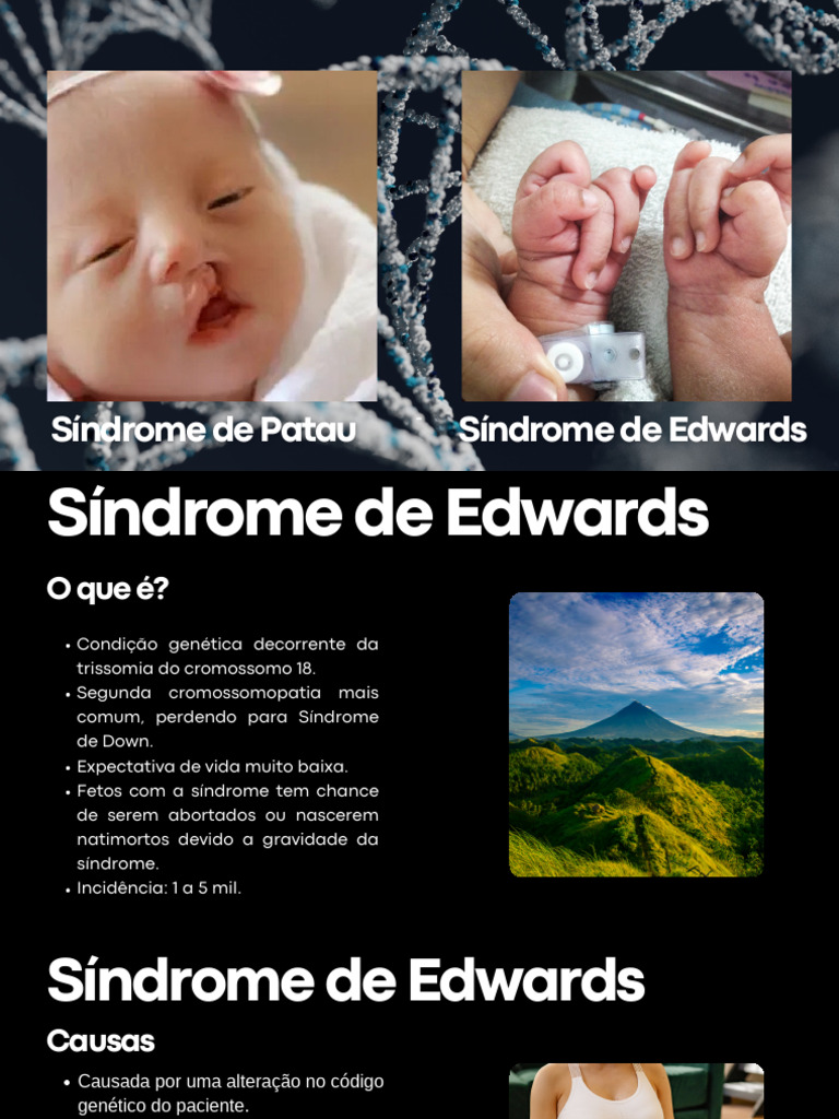Síndrome de Edwards e Patau | PDF | Doenças e distúrbios ...