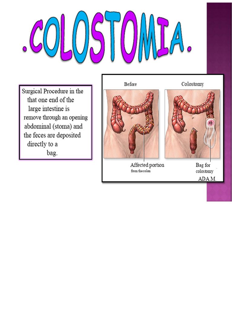 Colostomy Surgical Procedure Overview | PDF
