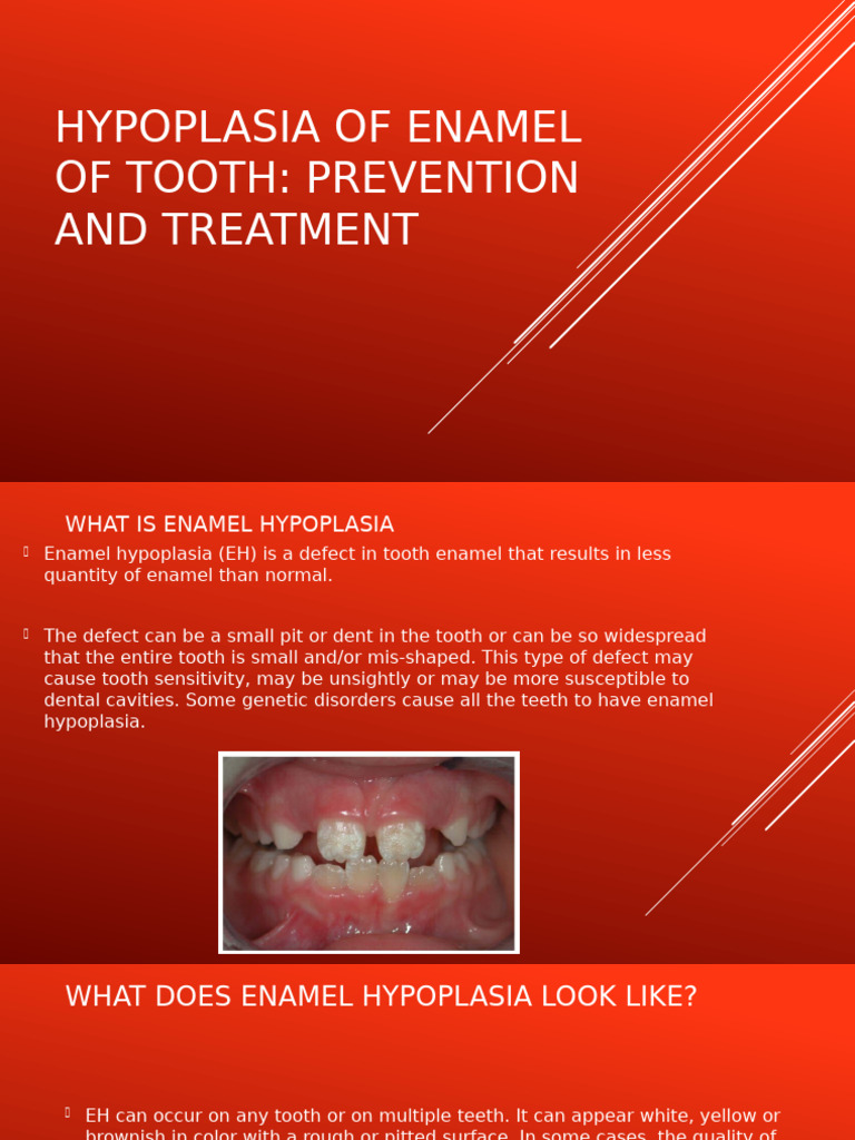 Hypoplasia of Enamel of Tooth Prevention and Treatment | PDF | Human ...
