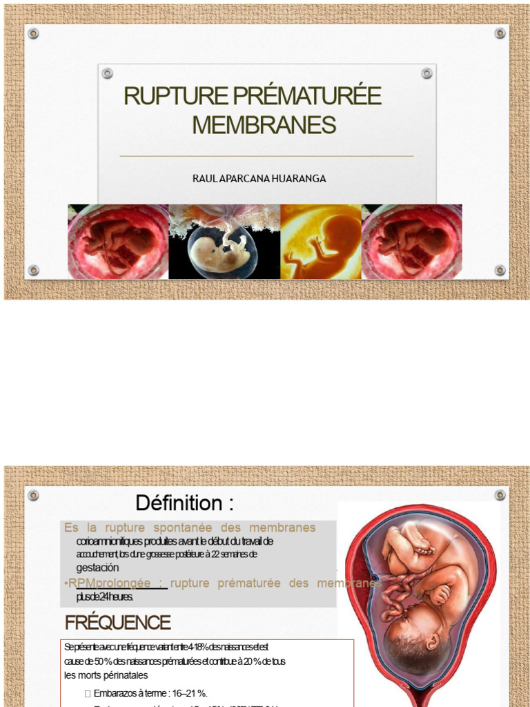 rupture-pr-matur-e-des-membranes-guide-pdf-grossesse-accouchement