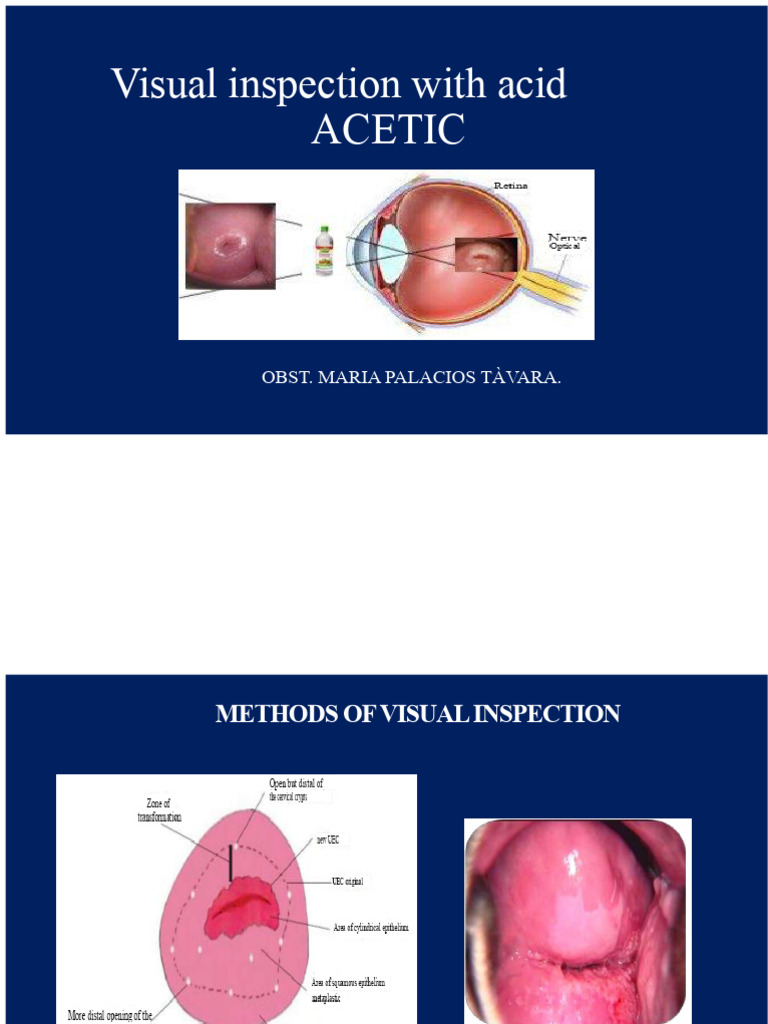 Visual Inspection with Acetic Acid Guide | PDF | Medical Specialties