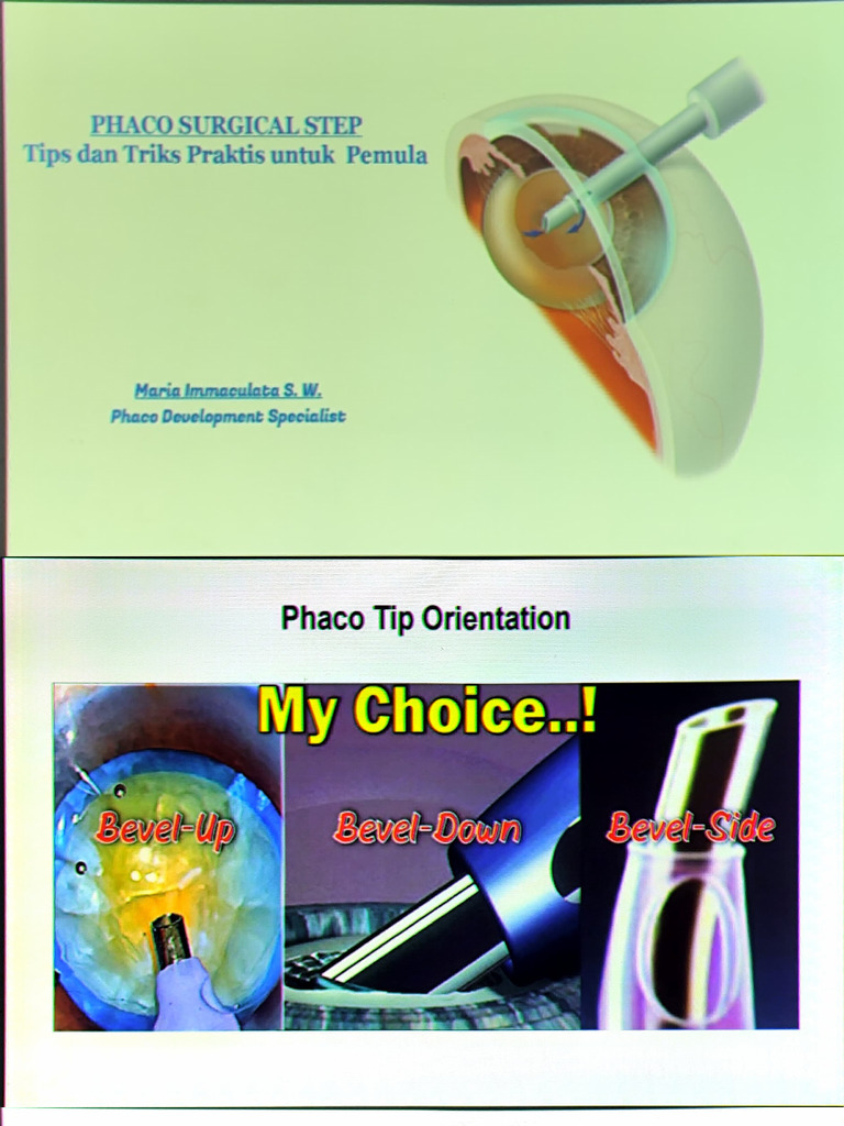 Phaco Step Alcon | PDF
