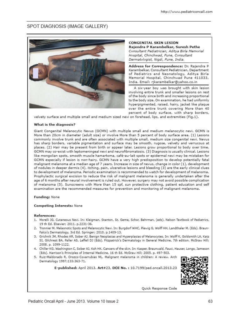 Giant Congenital Melanocytic Nevus Overview | PDF | Melanoma ...