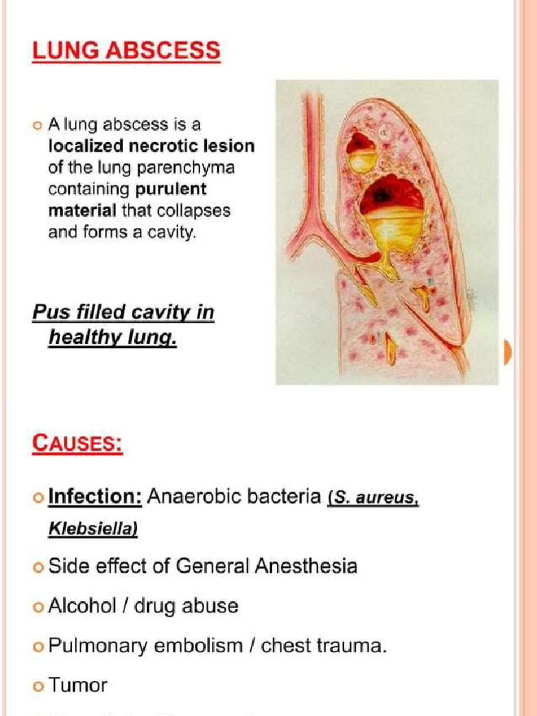 Lung Abscess | PDF