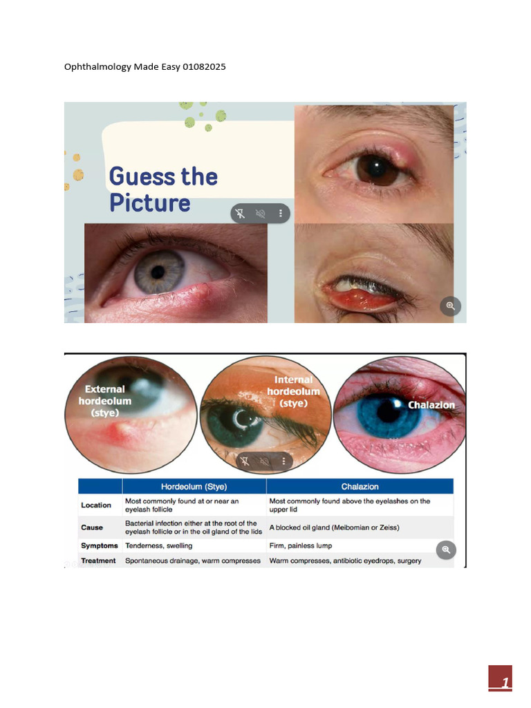 Ophthalmology Conditions Overview | PDF | Cornea | Ophthalmology