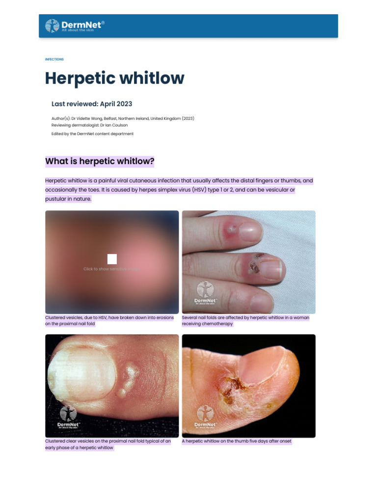 Understanding Herpetic Whitlow Symptoms | PDF | Medicine | Viral Diseases
