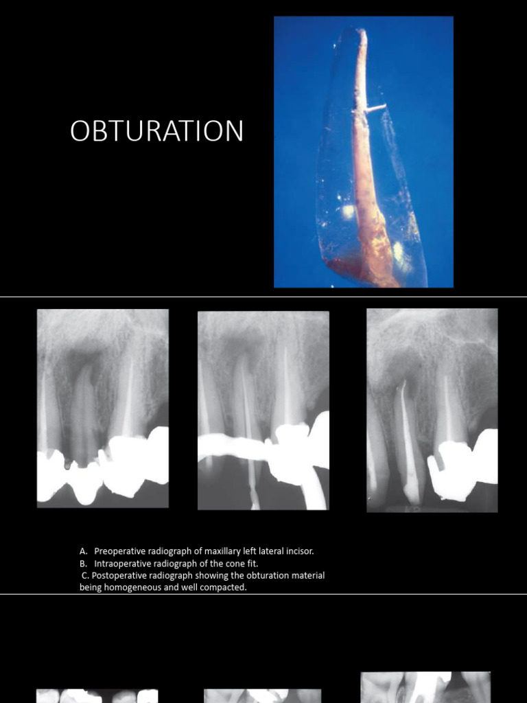 Root Canal Obturation Techniques Explained | PDF