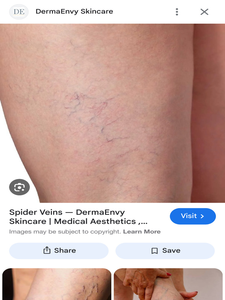 Spider Vein Treatment Options Explained | PDF