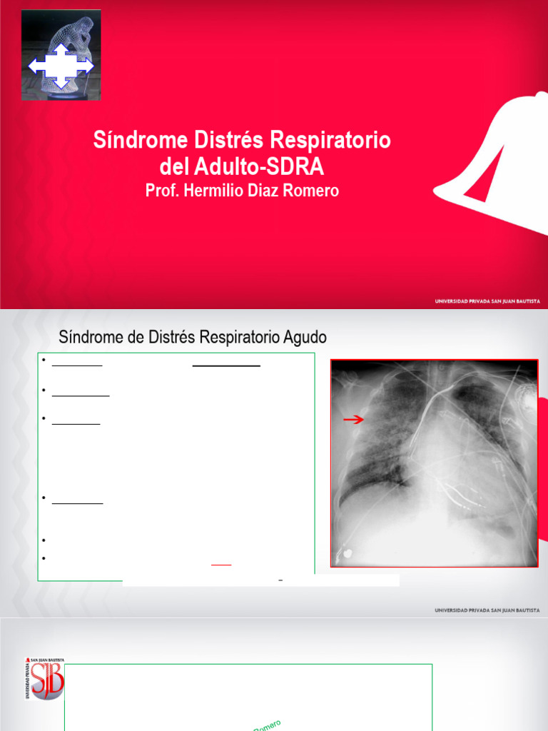 Guía Completa sobre SDRA en Adultos | PDF | Edema | Especialidades Medicas