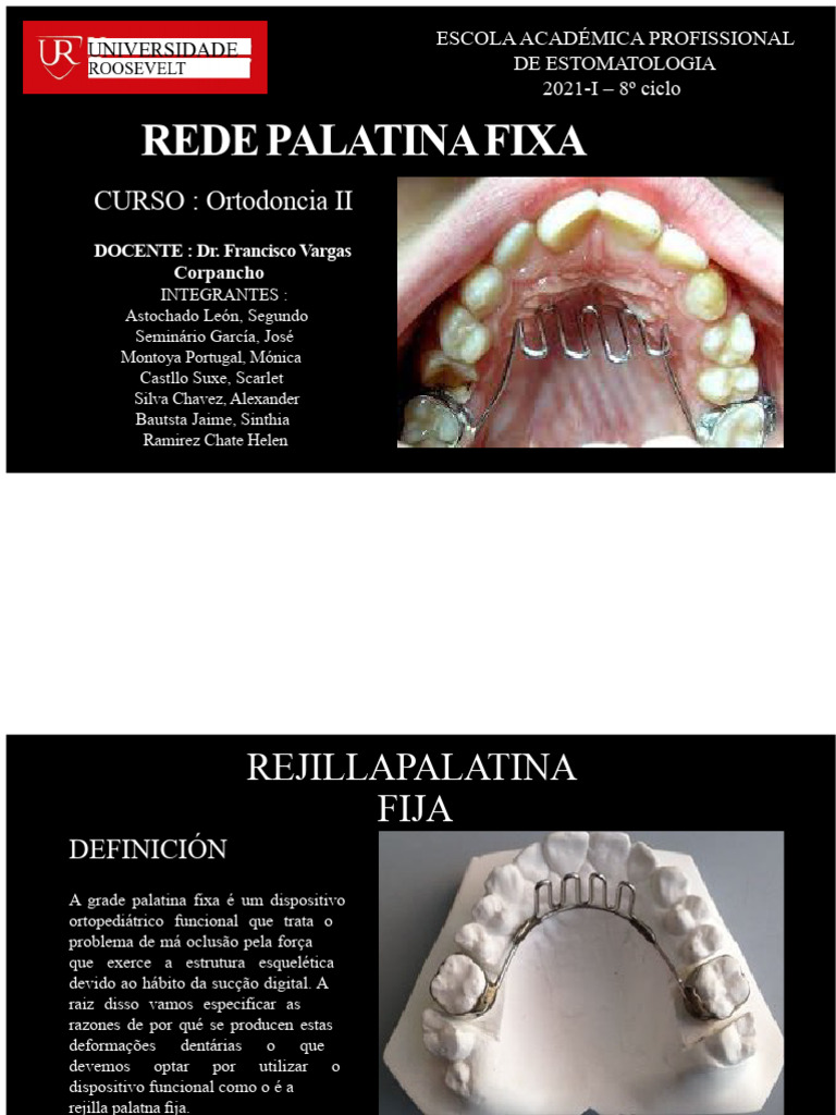 Rejilla Palatina Fixa Em Ortodontia PDF Odontologia