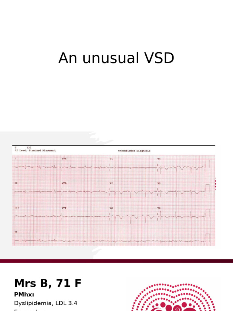 Unusual VSD Case Study in Elderly Patient | PDF