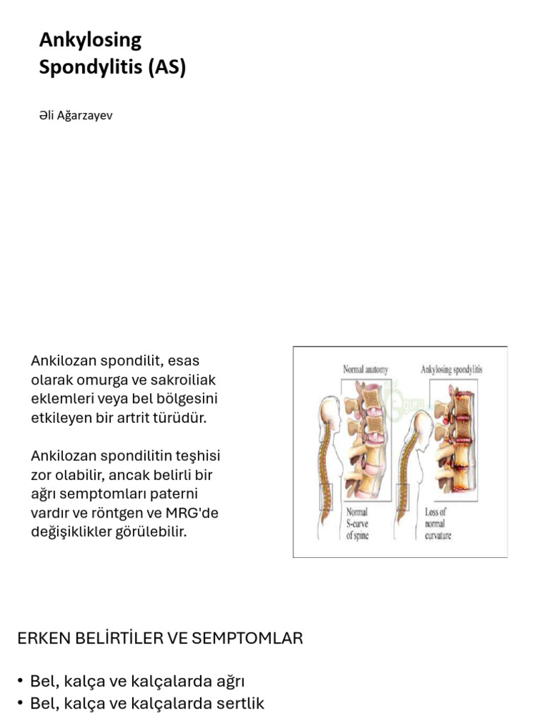 Ankylosing Spondylitis (As) | PDF