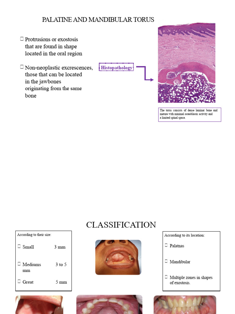 Palatine and Mandibular Torus | PDF | Prosthesis | Diseases And Disorders