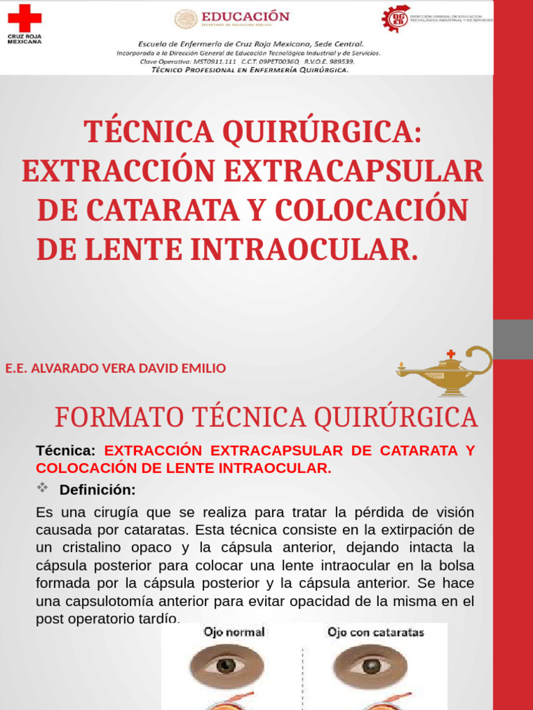 Extracción Extracapsular de Catarata | PDF | Ojo humano | Catarata