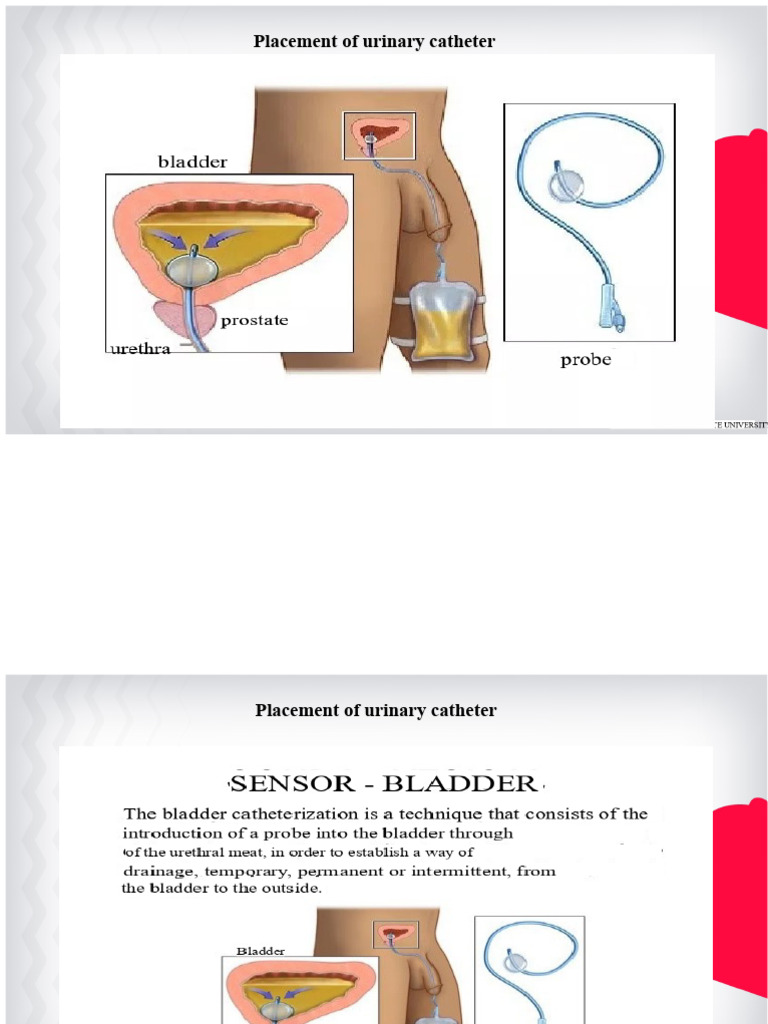 Urinary Catheter Placement Guide | PDF | Urinary System | Urology