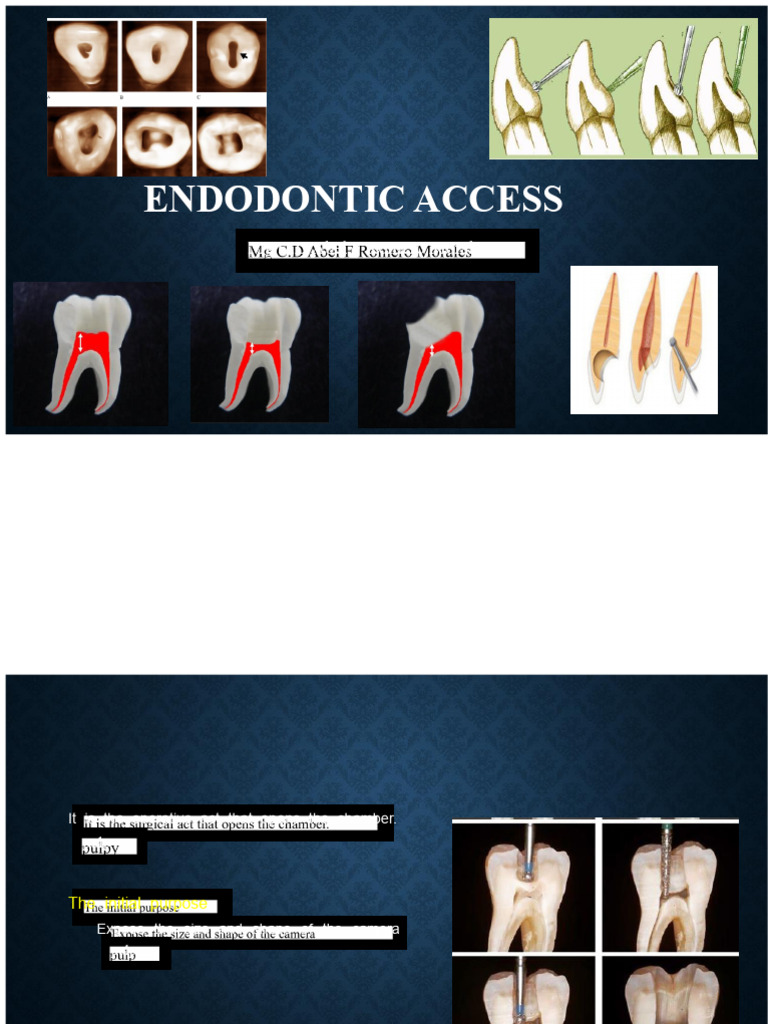 Endodontic access | PDF | Dental Anatomy | Medical Specialties