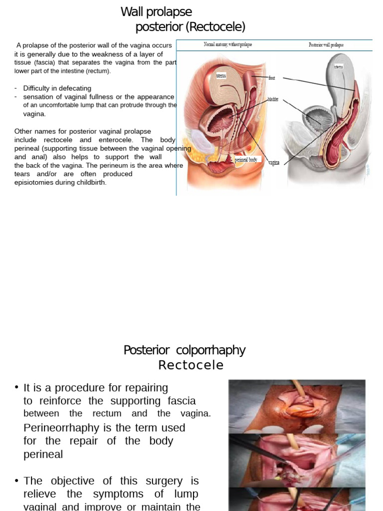 Posterior Vaginal Prolapse Surgery Guide | PDF | Vagina | Pelvis