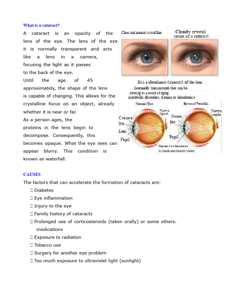 Understanding Cataracts: Causes and Treatment | PDF | Cataract ...