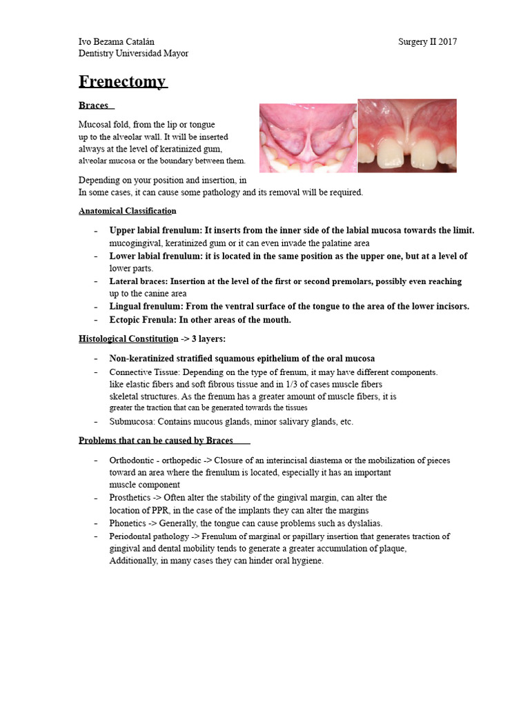 12.- Frenectomy | PDF | Tongue | Periodontology